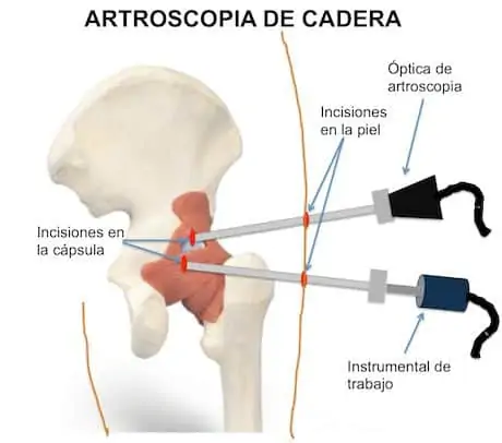 artroscopia_de_cadera